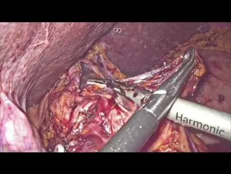 Gastrectomía laparoscópica para el cáncer de estómago distal