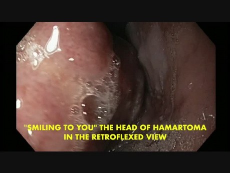Tumor gigante mesenquimal mixto pedunculado- Hamartoma del esófago