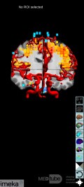 Planificación quirúrgica con neuronavegador en paciente con lesión de masa intracraneal. Glioma de alto grado.