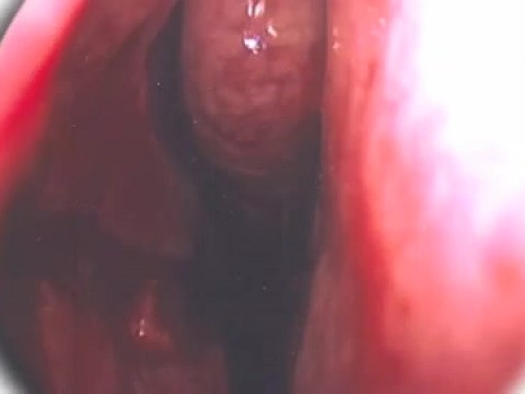 Septoplastia