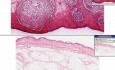 Forúnculo - histopatología - piel