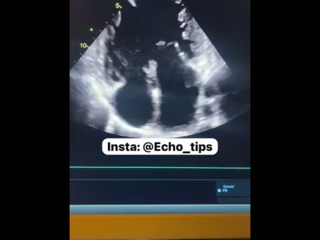Ventrículo fisiológicamente único
