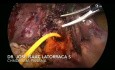 Colocación de Tubo en T Laparoscópico en Síndrome de Mirizzi Csendes Tipo IV 