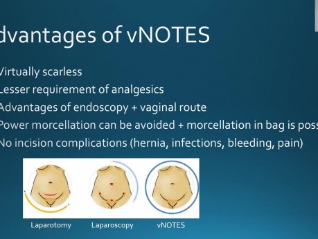 Laparoscopia y ablación por microondas guiada por USG de miomas - vNOTES miomectomía sin cicatriz