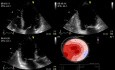 Evaluación ecocardiográfica de la insuficiencia de la válvula mitral: prueba de esfuerzo con dobutamina