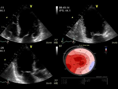 Evaluación ecocardiográfica de la insuficiencia de la válvula mitral: prueba de esfuerzo con dobutamina