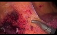Hemicolectomía derecha laparoscópica para cáncer de ciego, escisión mesocólica completa (EMC)