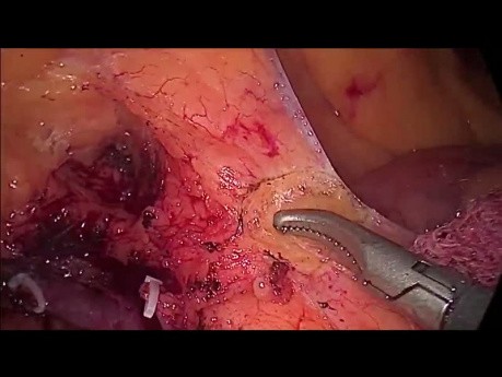 Hemicolectomía derecha laparoscópica para cáncer de ciego, escisión mesocólica completa (EMC)