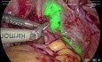 Adenomiomectomía laparoscópica mediante imágenes infrarrojo cercano (NIR) con verde de indocianina (ICG)