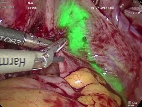 Adenomiomectomía laparoscópica mediante imágenes infrarrojo cercano (NIR) con verde de indocianina (ICG)
