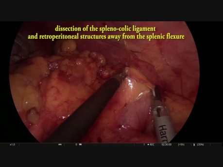 Resección interesfinteriana laparoscópica con ileostomía 