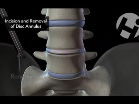 Discectomía anterior y fusión