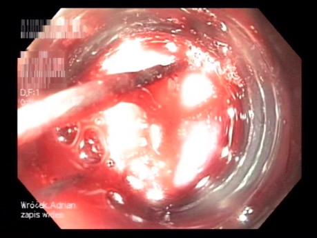 Várices esofágicas con sangrado activo: terapia endoscópica de rescate