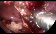 Colecistectomía laparoscópica para la colecistitis aguda