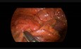 Resección parcial de colon por vía laparoscópica con técnica de grapadora en una paciente de 16 años