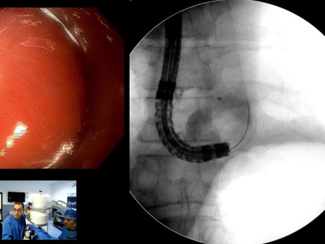 Fístula esofagogástrica anastomótica con colocación de pig-tail