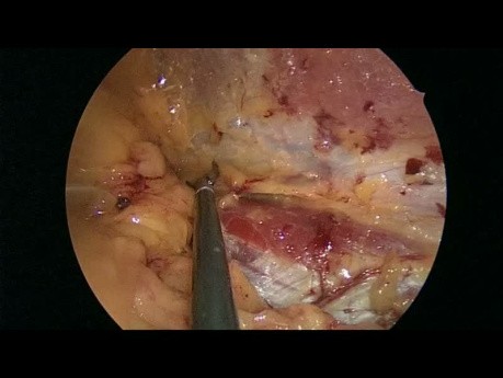 Triple neurectomía laparoscópica para el dolor crónico después de la reparación de una hernia inguinal