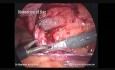 Reparación laparoscópica de hernia inguinal (TAPP). Paso a paso