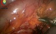Sigmoidectomía Laparoscópica por Vólvulo