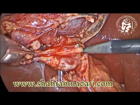 Colecistectomía laparoscópica (CL) Disección fina y anatomía