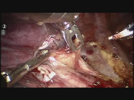 Lobectomía superior derecha - cirugía robótica 