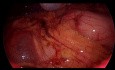 Laparoscopia Diagnóstica con Biopsia... Y TB