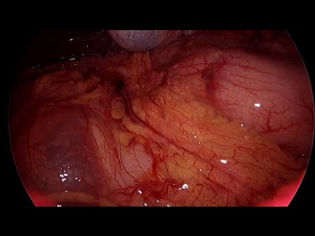 Laparoscopia Diagnóstica con Biopsia... Y TB