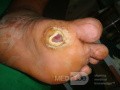 Úlcera del pie diabético - neuropatía - asociada con osteomielitis