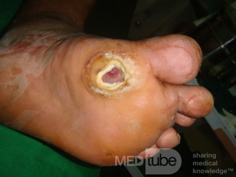 Úlcera del pie diabético - neuropatía - asociada con osteomielitis
