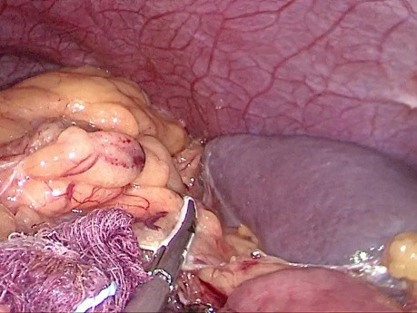 Colectomía izquierda laparoscópica con preservación de vasos mesentéricos inferiores para cáncer de la flexura esplénica