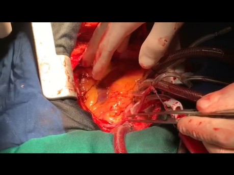 Serie de vídeos de reparación quirúrgica de la RVS tras un IM con una nueva técnica de exclusión