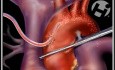 Defecto del tabique ventricular