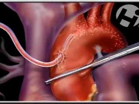 Defecto del tabique ventricular