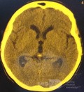 Tercera ventriculostomía endoscópica en un caso benigno de síndrome de Aicardi con hidrocefalia obstructiva y malformación de Chiari tipo 1