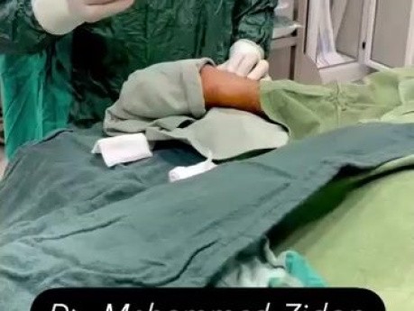 Angiografía coronaria por acceso radial