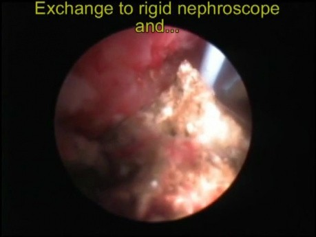 PCNL - Nefroscopio flexible