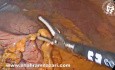 Resección laparoscópica de tumor del estroma gastrointestinal (GIST)