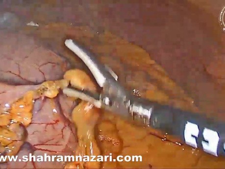 Resección laparoscópica de tumor del estroma gastrointestinal (GIST)