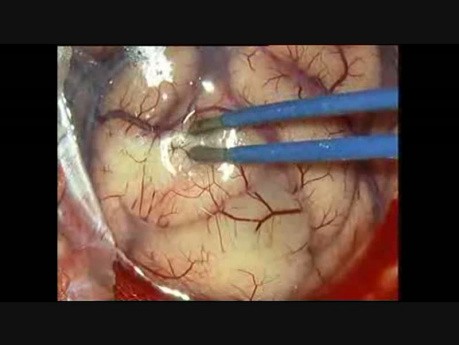 Glioma parietal