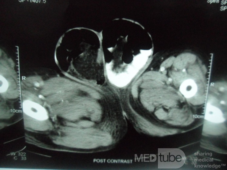 TC de abdomen en paciente con hernia inguinal bilateral
