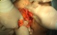 Prolapso del útero - Procedimiento de Cabestrillo, Parte 2