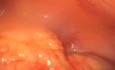Urgencias ginecologicas abdomen agudo absceso tubarico