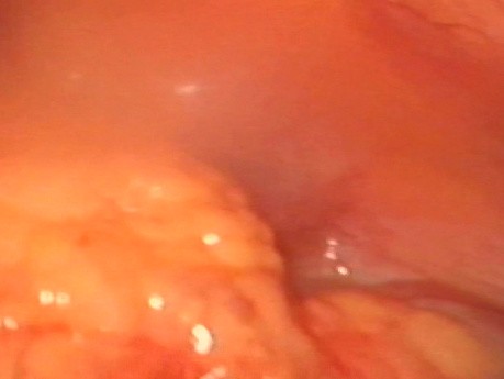 Urgencias ginecologicas abdomen agudo absceso tubarico