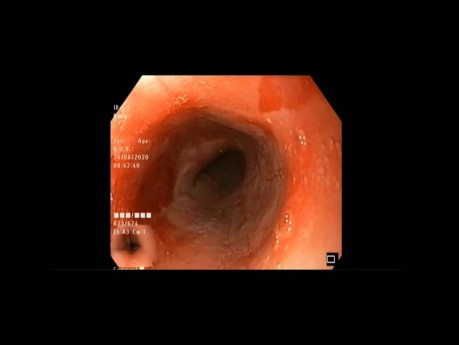 Desgarro esofágico durante la endoscopia superior