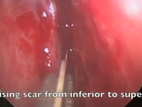 Cicatrización masiva en la cavidad nasal - CENS