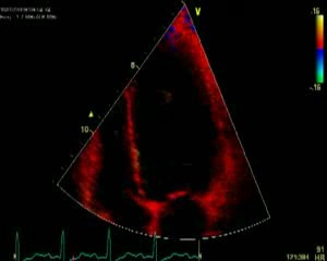 Disincronía en el eco cardíaco