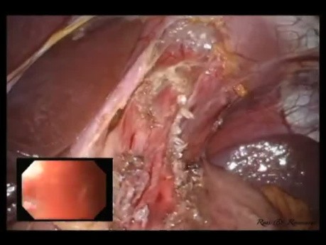 Miotomía de Heller laparoendoscópica de sitio único (LESS) y fundoplicatura anterior