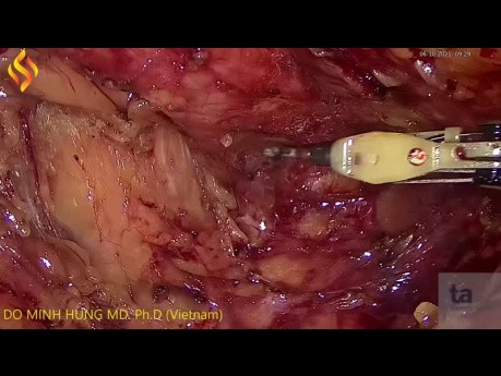 Resección anterior baja para cáncer de recto enorme