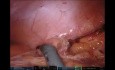Vaginoplastia uterino-colon-sigmoidea robótica total que restaura la función sexual y la fertilidad
