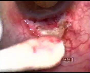 Glaucoma neovascular - operación